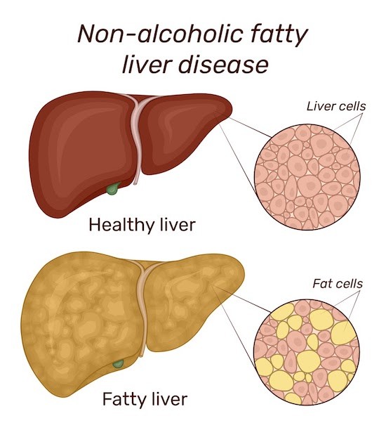 隠れたパンデミック：脂肪肝疾患の真の負担を明らかにした研究成果がNEJMに掲載された