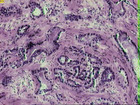 MicroRNA-34がp53と共同で前立腺がんを抑制
