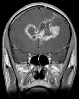 悪性グリオーマの新しい治療法へつながる発見