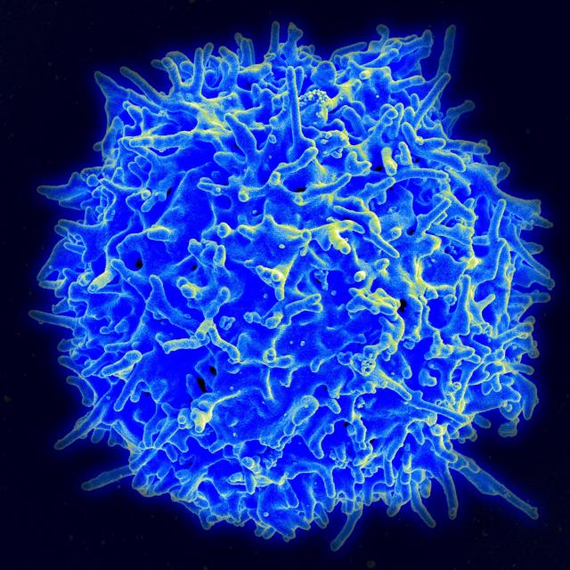 シグナルの入れ違いでCD4T細胞が機能麻痺。がん免疫療法の改善なるか?