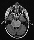 ヒストンの変異が悪性小児脳腫瘍に関与