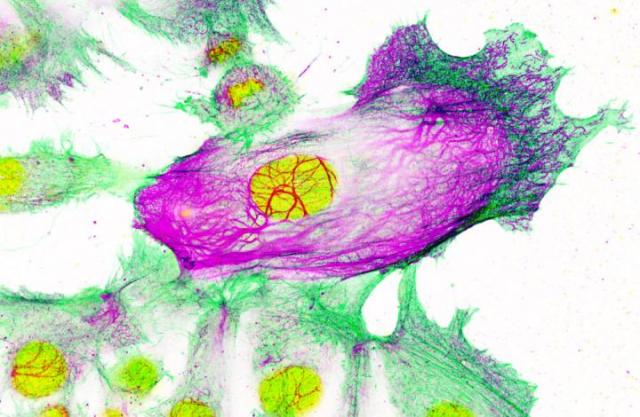ER陽性乳がんの転移と薬剤耐性を転写因子スイッチが誘発することを初期段階の研究が示唆