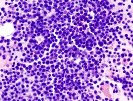 多発性骨髄腫の薬剤耐性化に対応する新しい手法