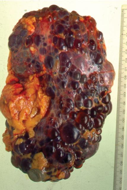 多様な多嚢性疾患の進行を制御するPKD1遺伝子