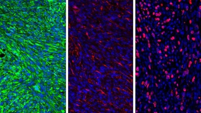 ナノ粒子と阻害剤が免疫系を刺激し、脳腫瘍を克服。血液脳関門を通過し、腫瘍の免疫反応に対するシールドを破壊。
