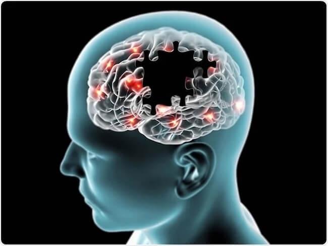 腸内環境が悪い人は、アルツハイマー病の発症リスクが高い可能性。早期発見と新たな治療法につながる世界初の研究。