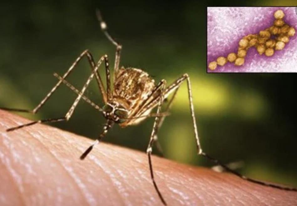 ウエストナイル感染での致命的症状、抗インターフェロン自己抗体が影響