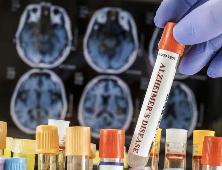 アルツハイマー病血液検査に新展開!ALZpath pTau217アッセイが高精度を示す