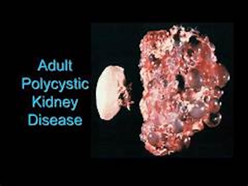 細胞の宅配便を追跡!難病・多発性嚢胞腎(PKD)治療への新たな道
