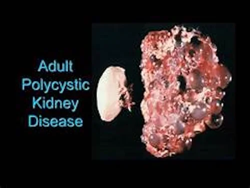 細胞の宅配便を追跡！難病・多発性嚢胞腎（PKD）治療への新たな道