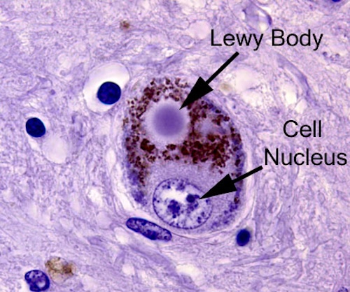 大気汚染PM2.5がレビー小体型認知症を引き起こす仕組みを解明