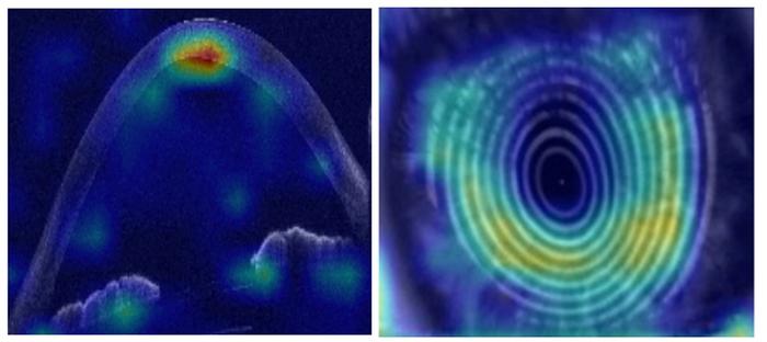 AIが若者の失明を防ぐ。円錐角膜の進行を初診で予測し、早期治療へ