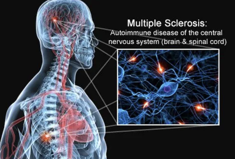 多発性硬化症の発症7年前に兆候あり？UCSFが血液中のタンパク質から特定